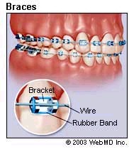 braces